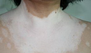 白癜风哪里治疗好 白癜风哪里治疗好